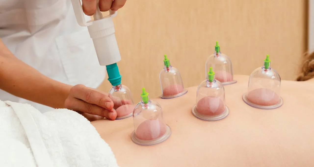 Hijama Therapy