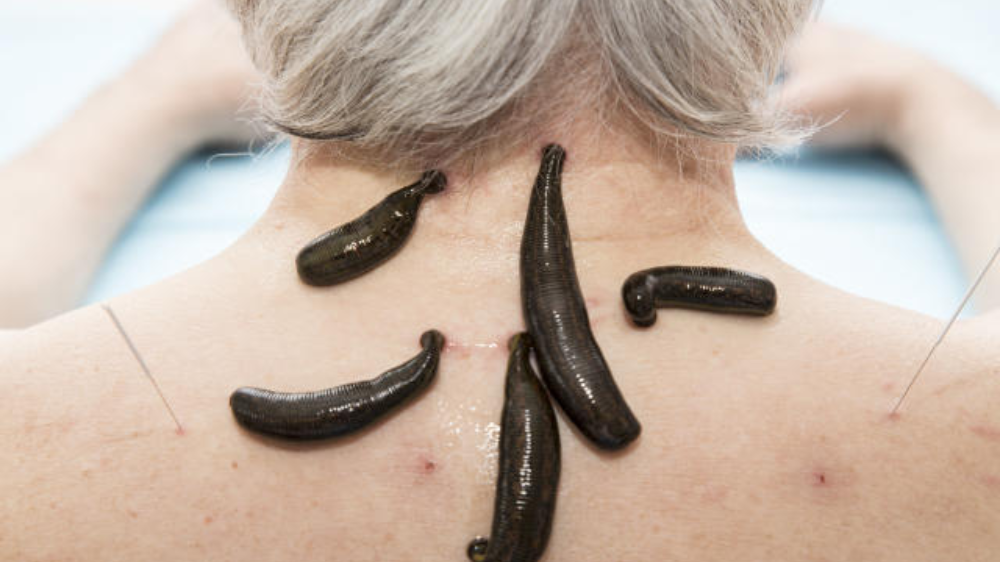 Leech Therapy